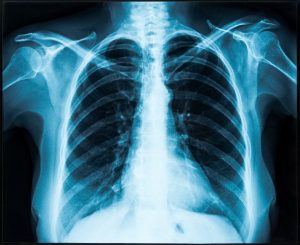lung injury compensation calculator