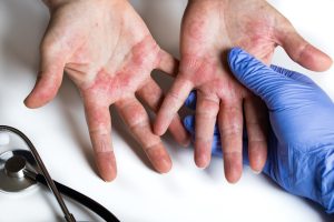 A rash on a person's hands caused by a food allergy.