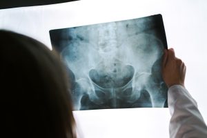 a healthcare professional examining an x-ray of a patient's pelvis